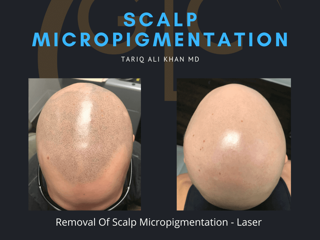Gentle Care Laser Tustin Before and After picture - Scalp micropigmentation